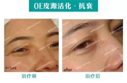 德国fre抗衰仪器