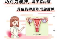 卵巢囊肿的成因与管理了解、预防与治疗