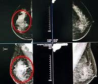 炎性乳腺癌的治疗方法