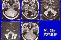 良恶性间皮肿瘤病变丨影像表现
